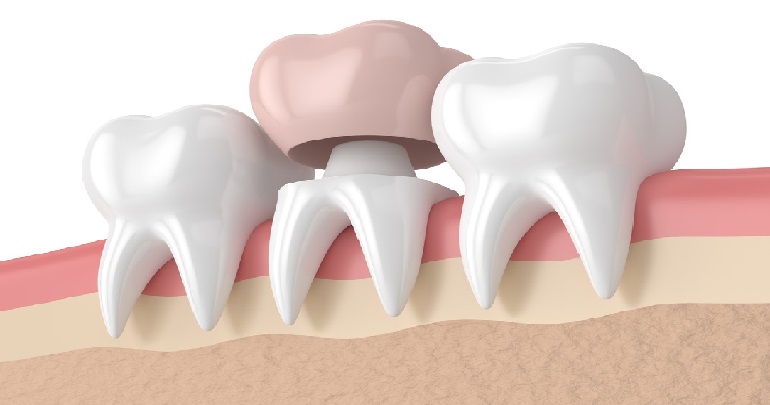 Восстановление жевательной функции и исправление эстетики зубов